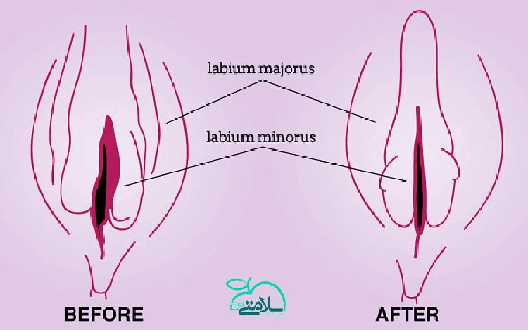 پلاسماتراپی واژن چیست و چه کاربردهایی دارد؟ 